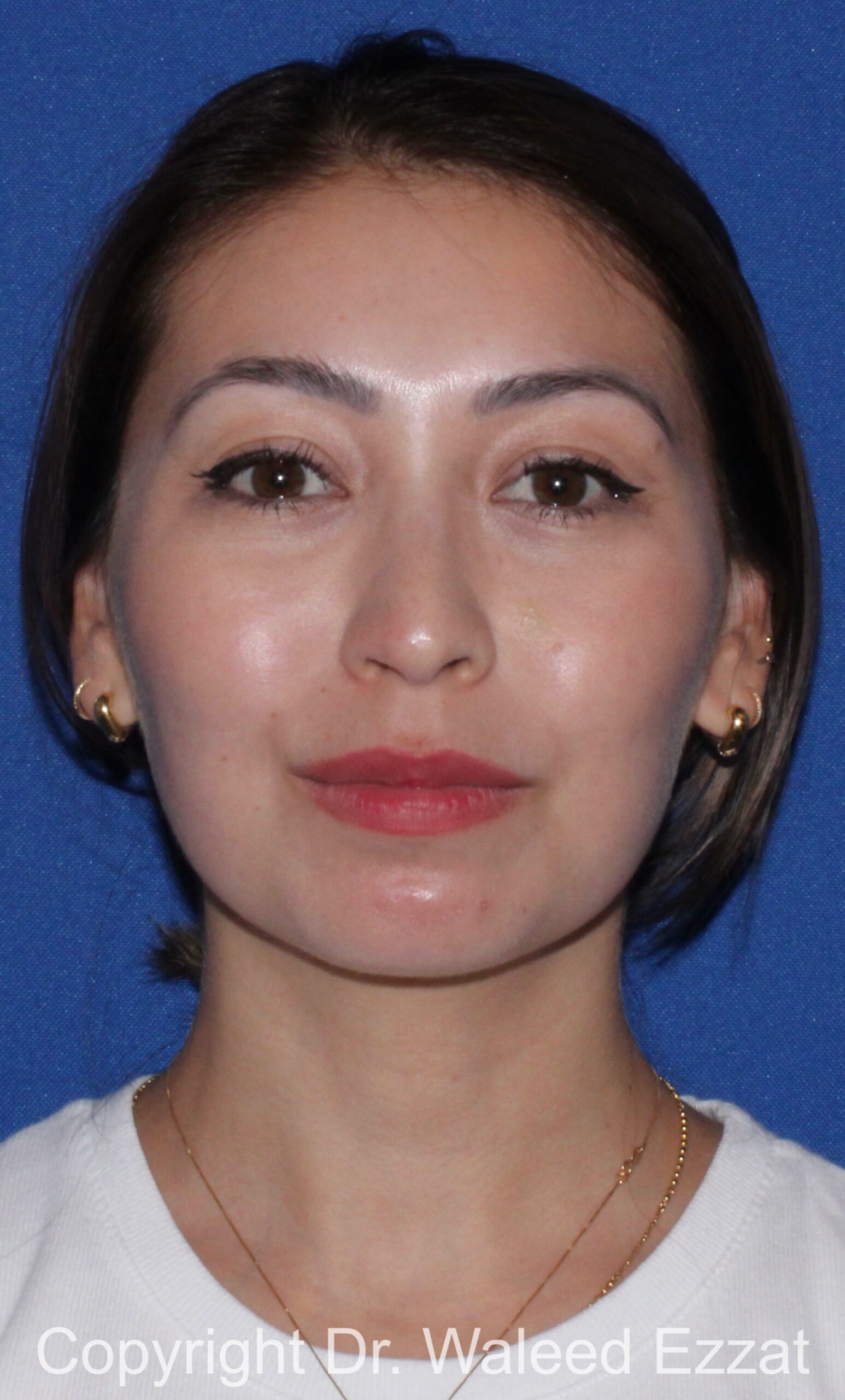 Buccal Fat Excision Patient Photo - Case 24 - after view-2