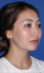 Buccal Fat Excision - Case 24 - After