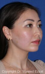 Buccal Fat Excision - Case 24 - Before