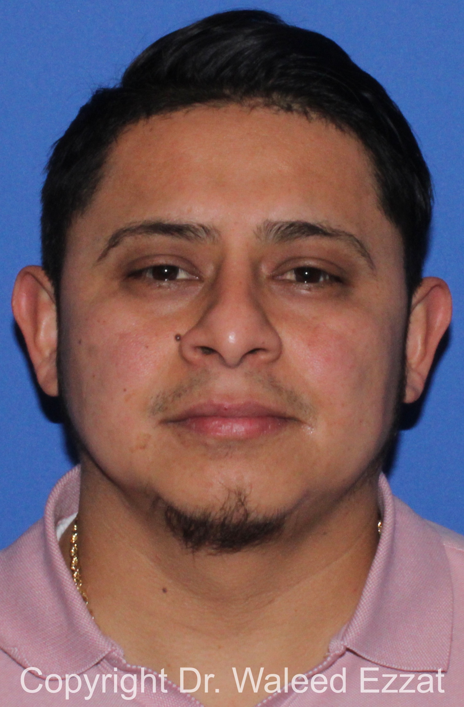 Facial Contouring Patient Photo - Case 30 - after view-2