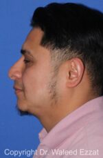Chin Augmentation - Case 30 - After
