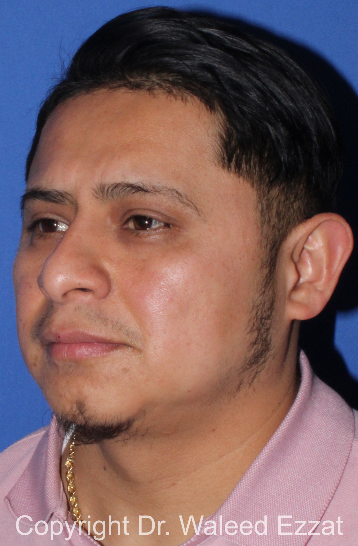 Facial Contouring Patient Photo - Case 30 - after view-1