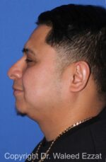 Chin Augmentation - Case 30 - Before