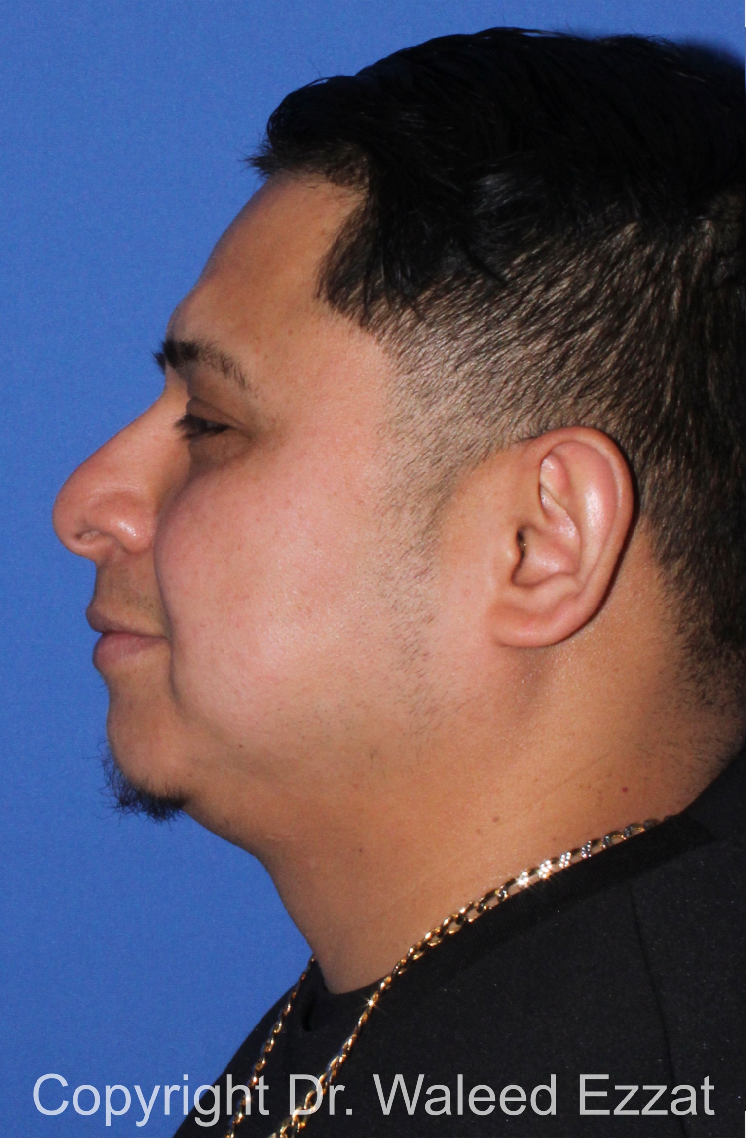 Facial Contouring Patient Photo - Case 30 - before view-