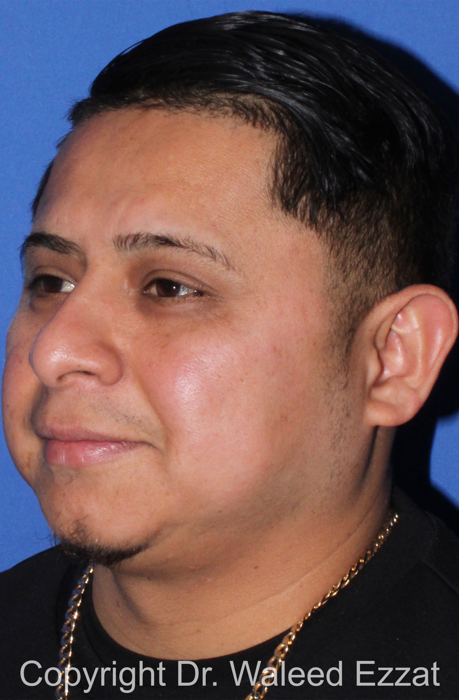 Facial Contouring Patient Photo - Case 30 - before view-1