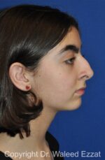 Chin Augmentation - Case 32 - Before