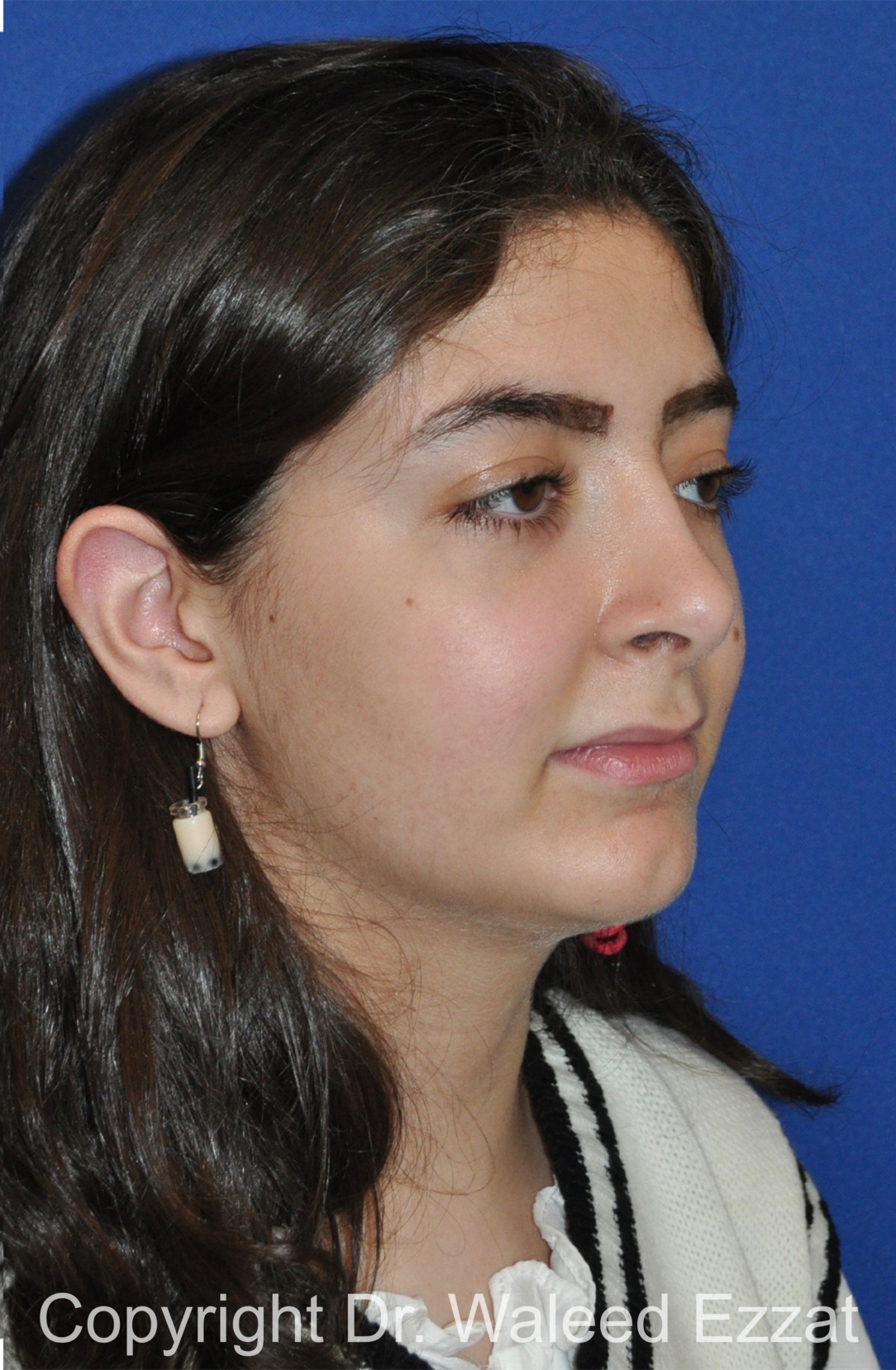 Chin Augmentation Patient Photo - Case 32 - after view-1