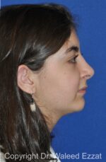 Chin Augmentation - Case 32 - After