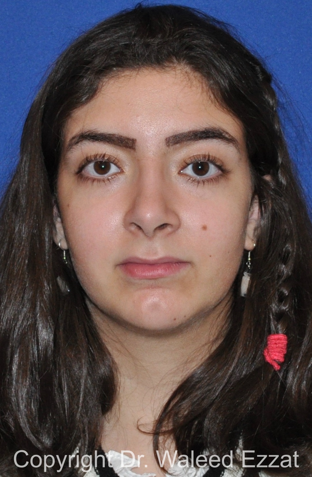 Chin Augmentation Patient Photo - Case 32 - after view-2