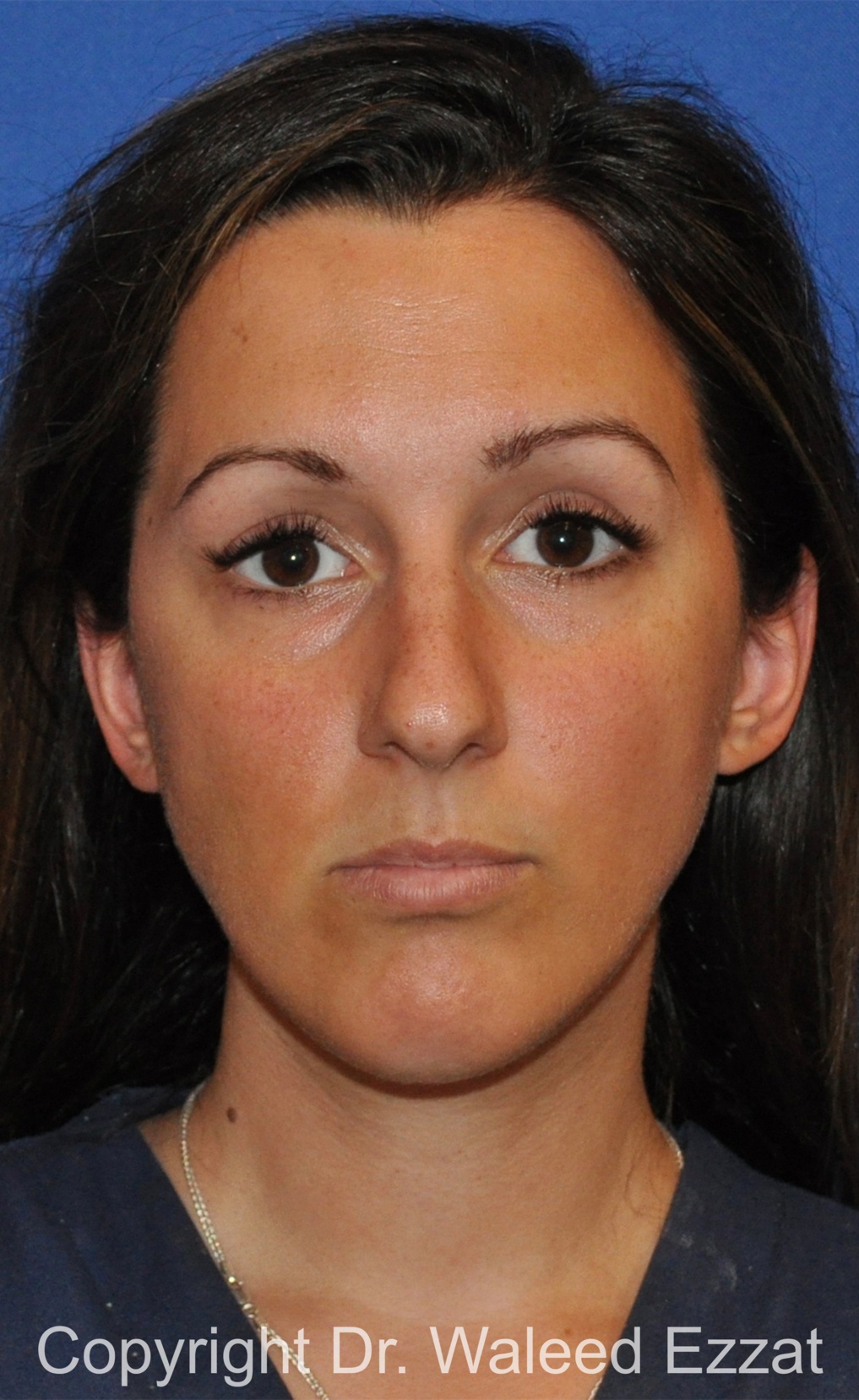 Chin Augmentation Patient Photo - Case 33 - before view-2