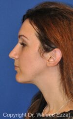 Chin Augmentation - Case 33 - After