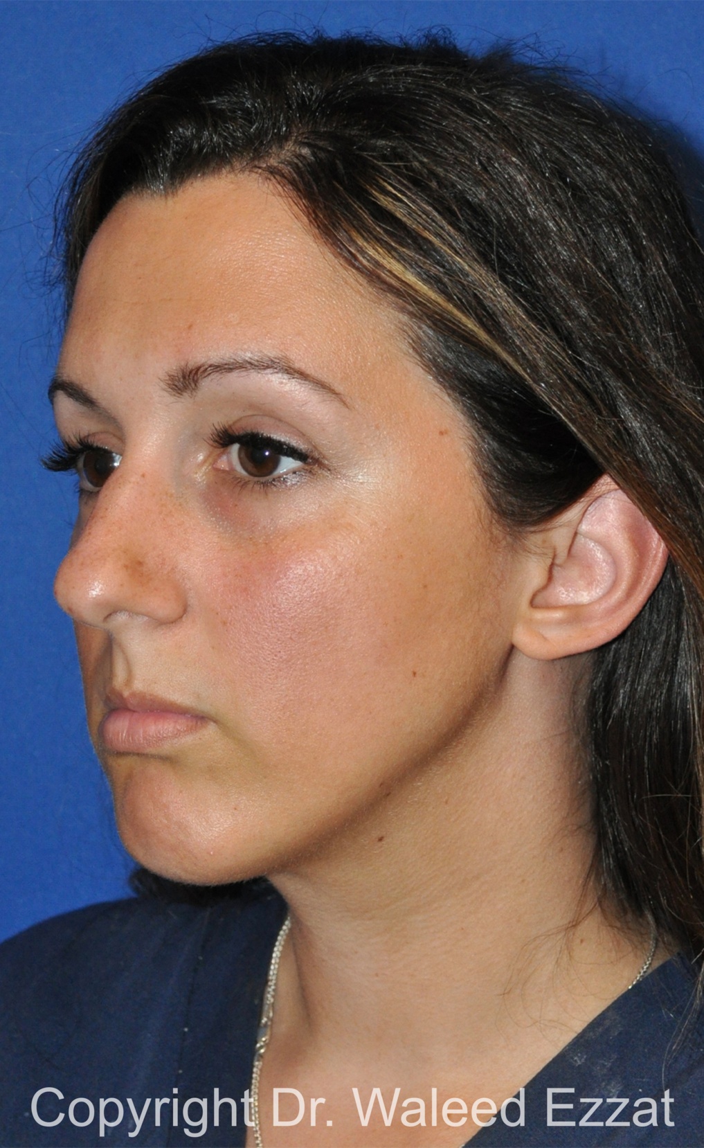 Chin Augmentation Patient Photo - Case 33 - before view-1