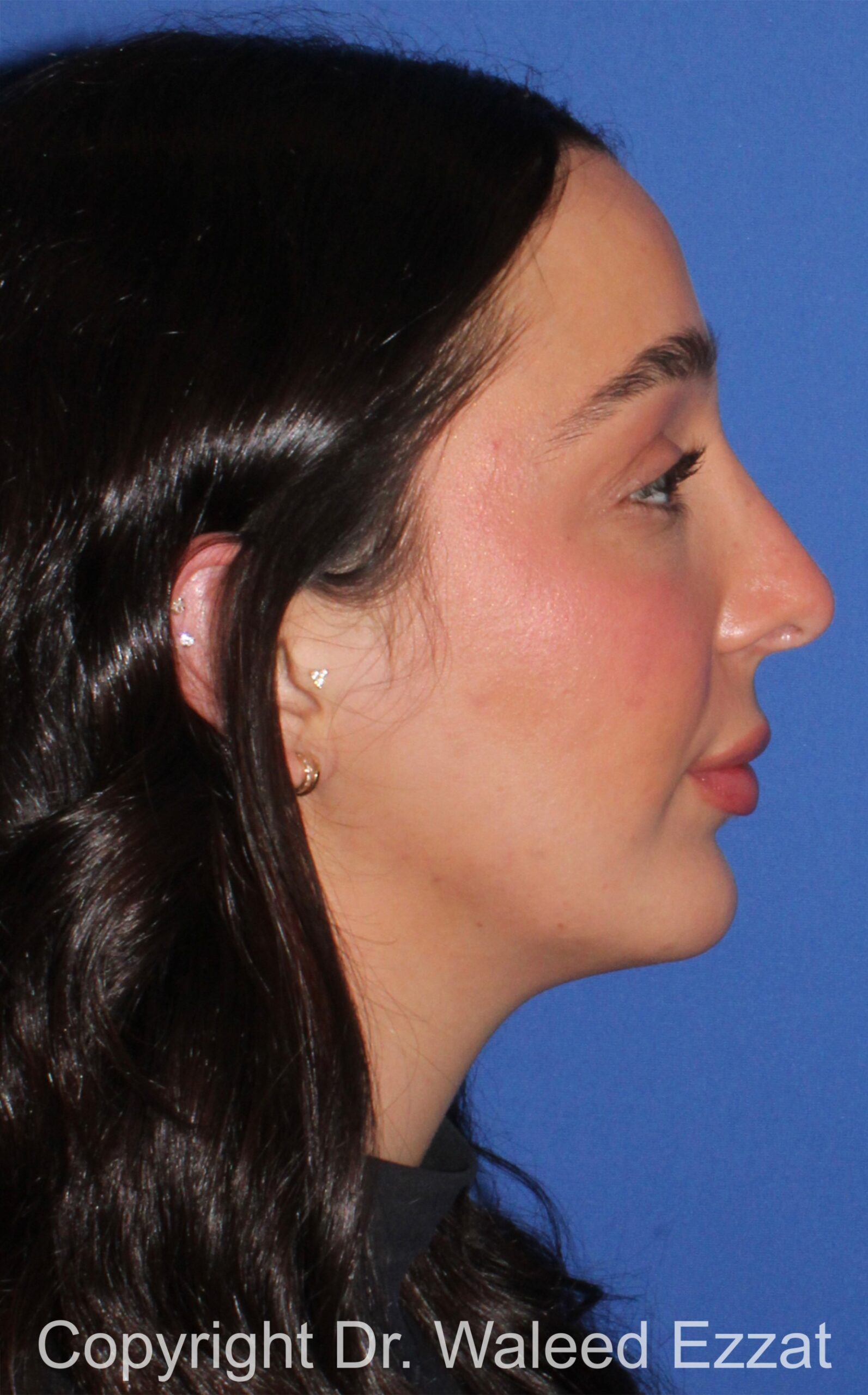 Chin Augmentation Patient Photo - Case 35 - after view