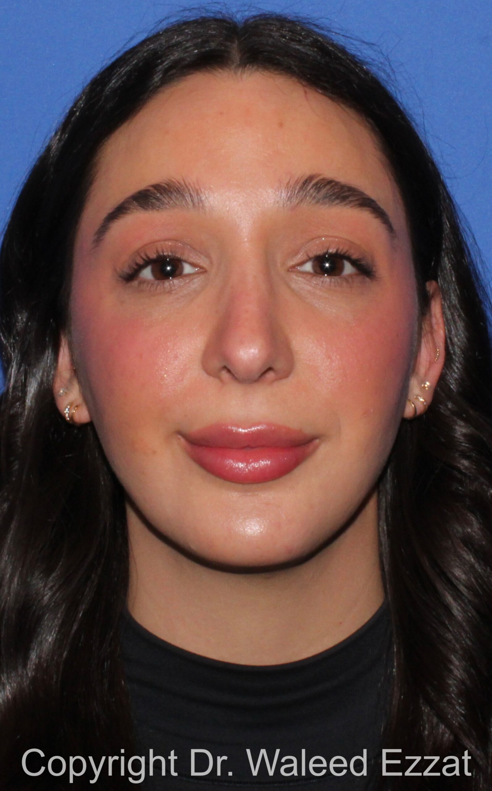 Chin Augmentation Patient Photo - Case 35 - after view-2