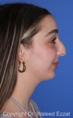 Chin Augmentation - Case 35 - Before