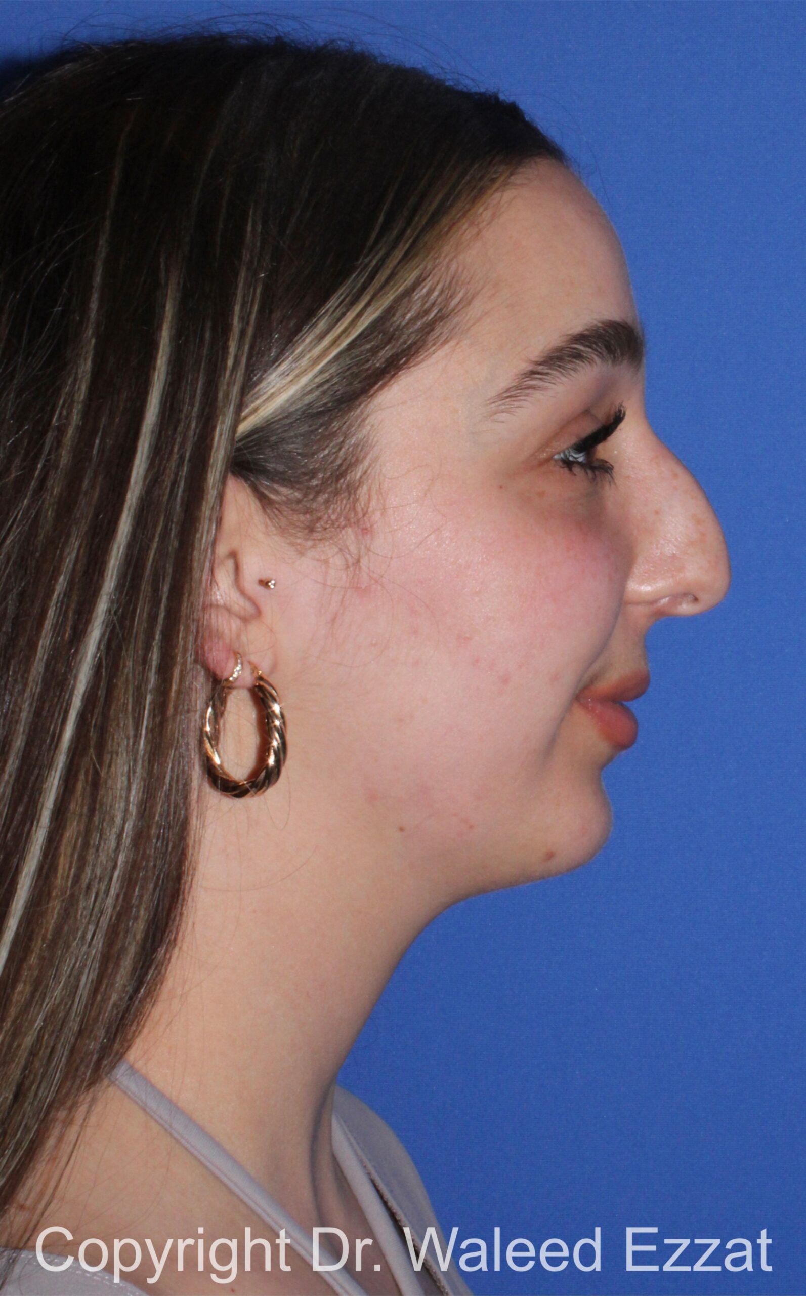 Chin Augmentation Patient Photo - Case 35 - before view-
