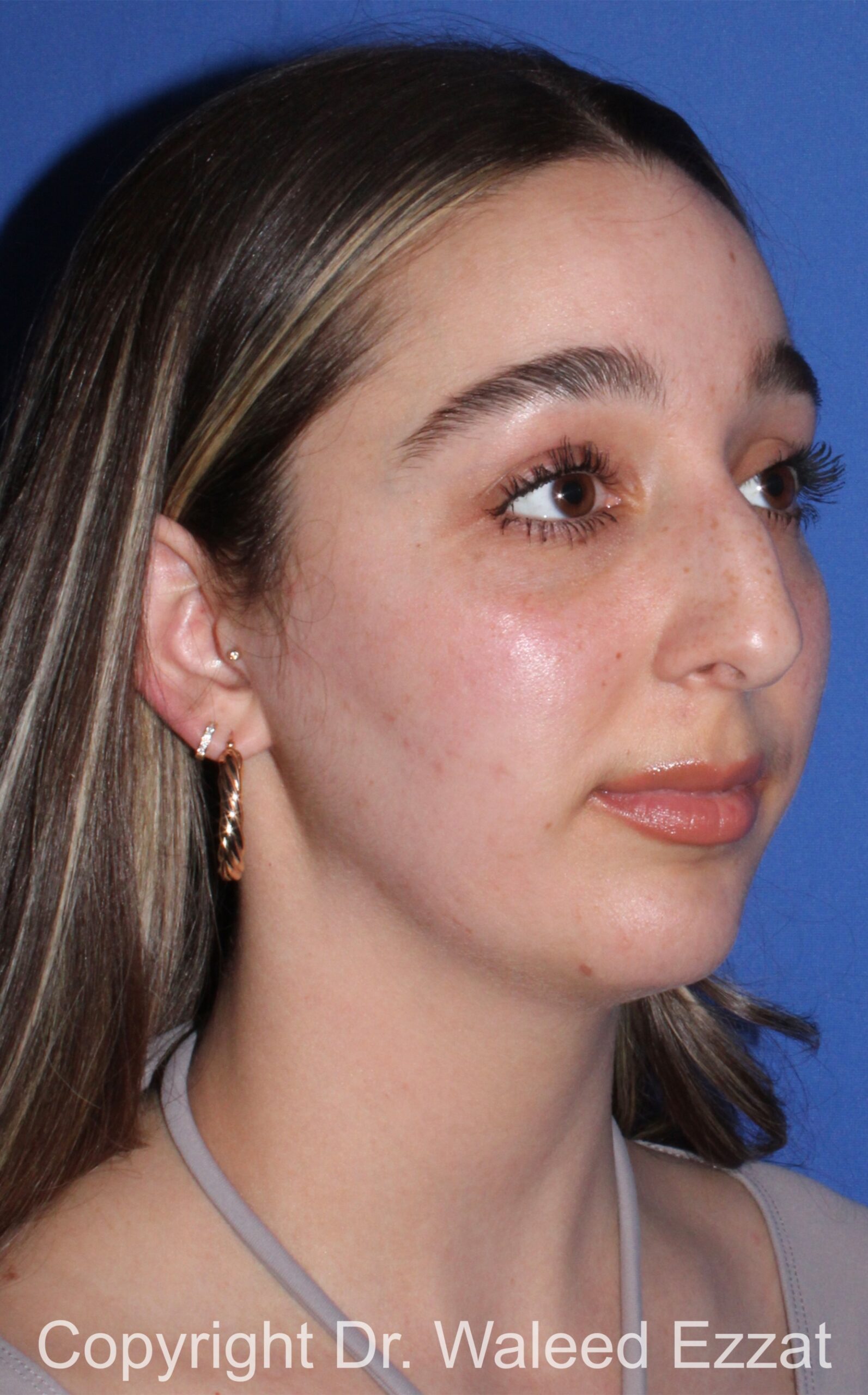 Chin Augmentation Patient Photo - Case 35 - before view-1