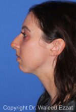 Chin Augmentation - Case 36 - Before