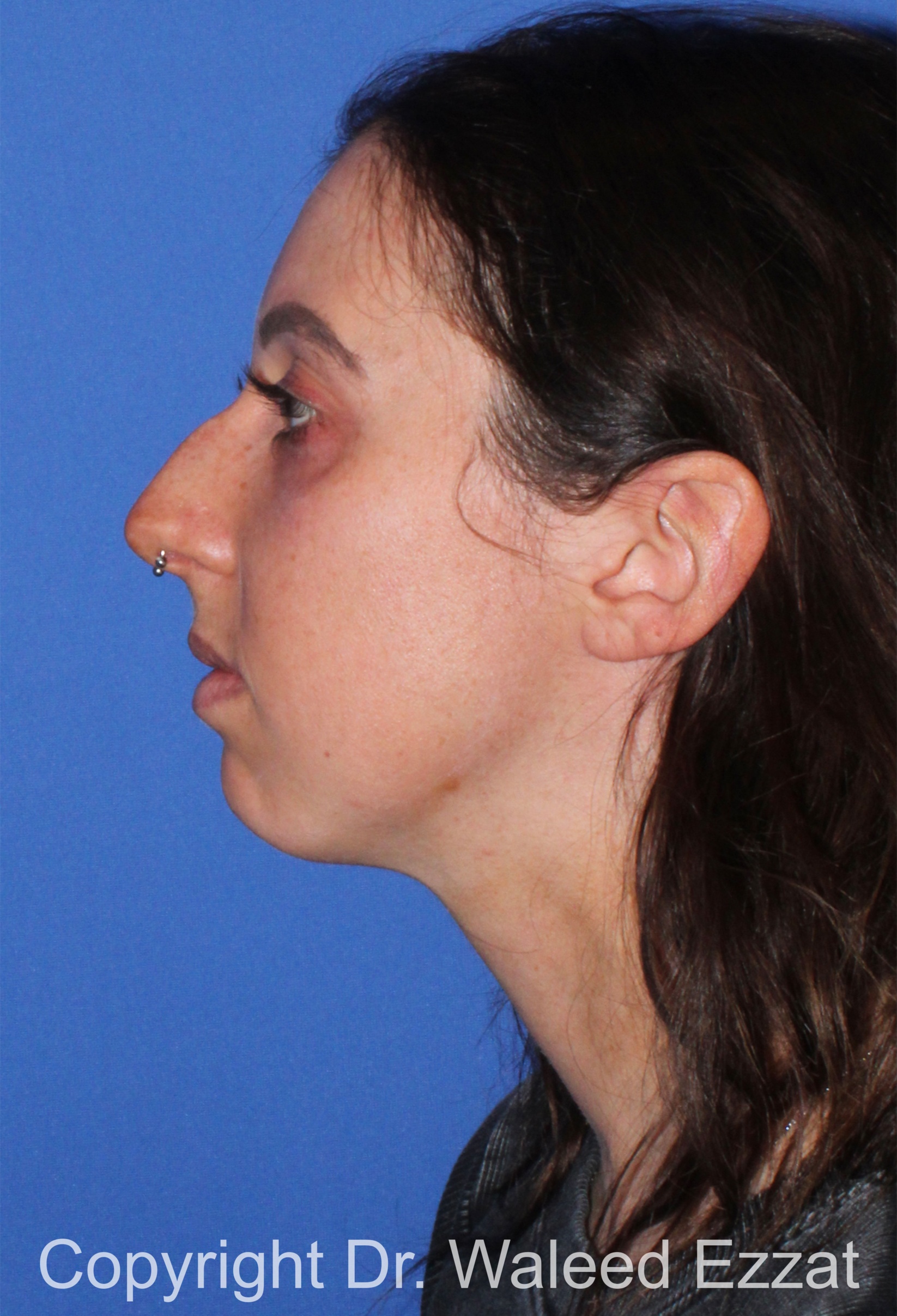 Chin Augmentation Patient Photo - Case 36 - before view-