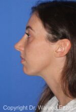 Chin Augmentation - Case 36 - After