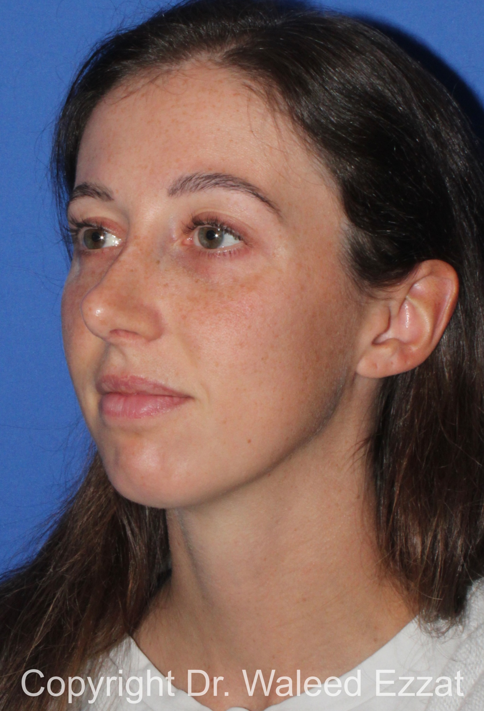 Chin Augmentation Patient Photo - Case 36 - after view-1