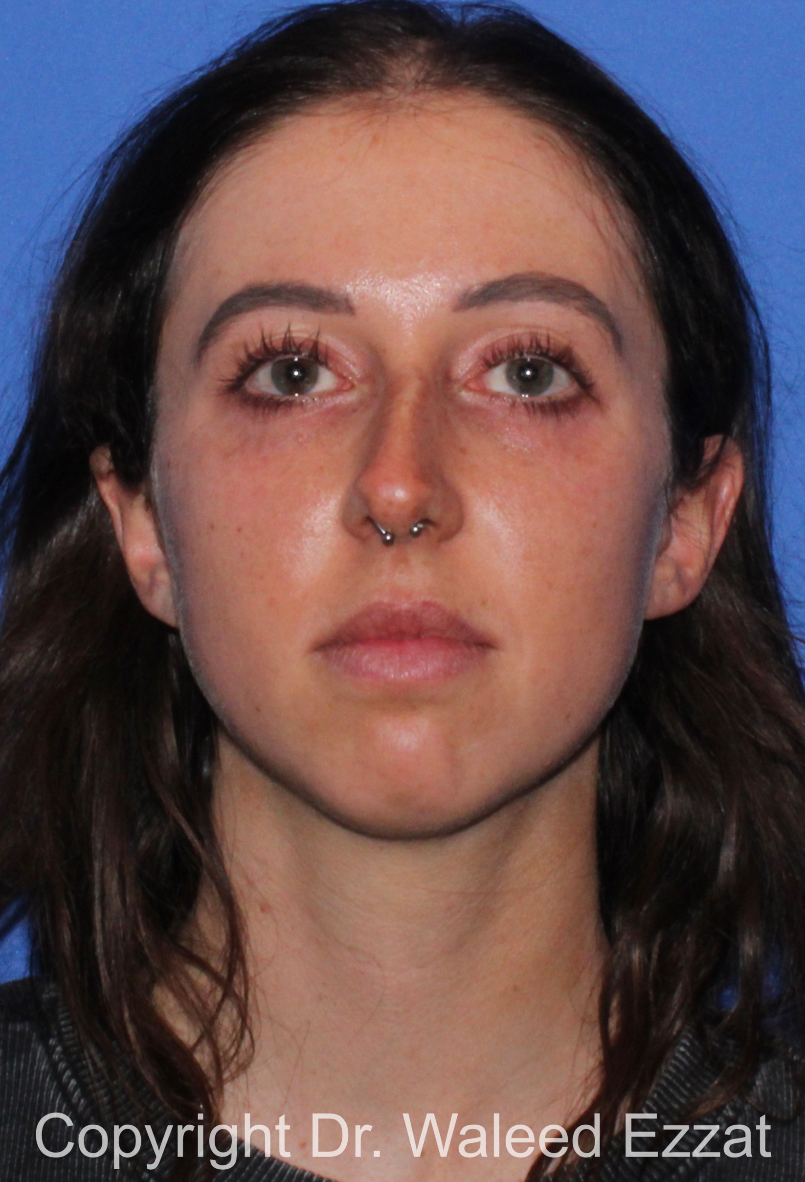 Chin Augmentation Patient Photo - Case 36 - before view-2