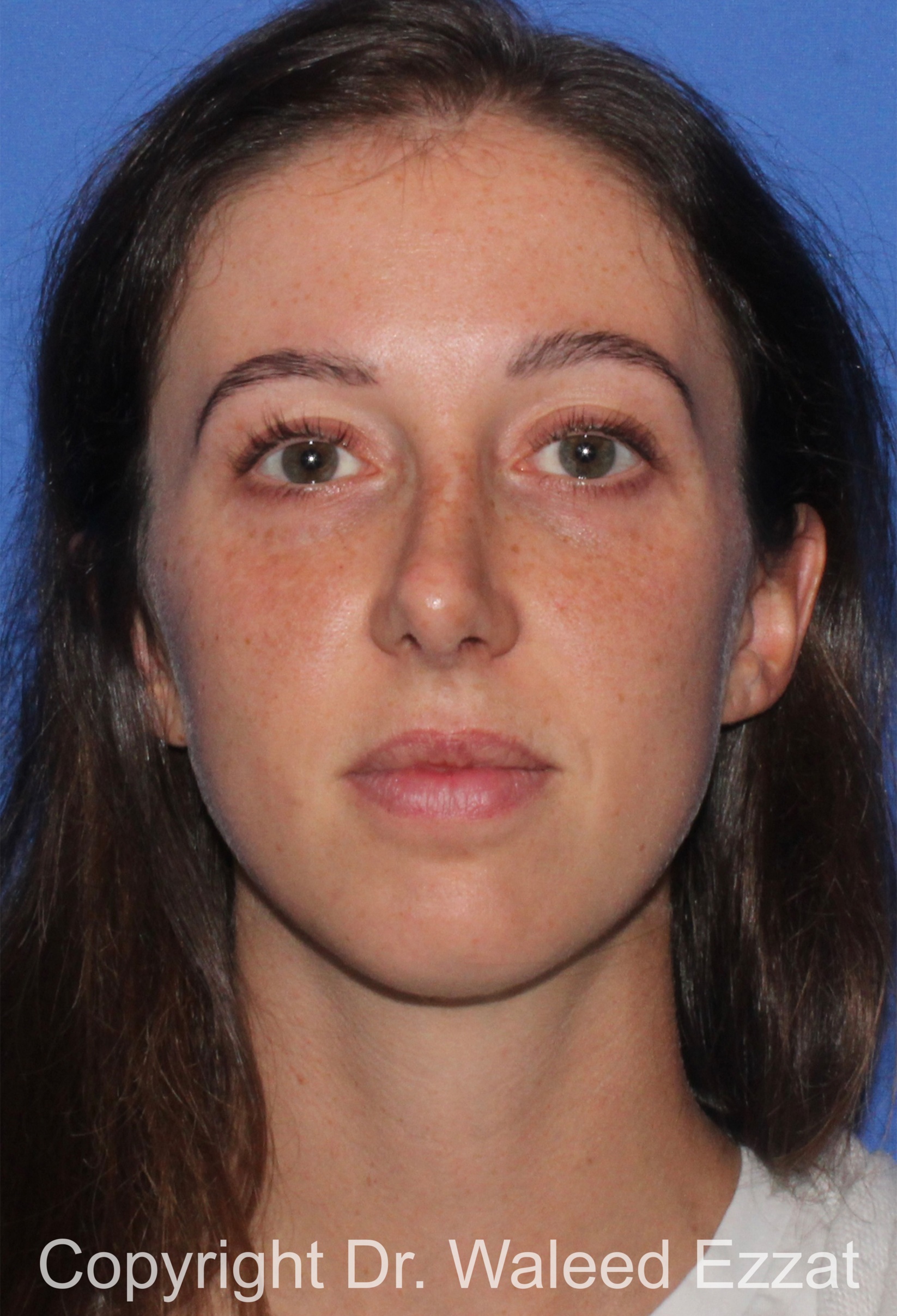 Chin Augmentation Patient Photo - Case 36 - after view-2