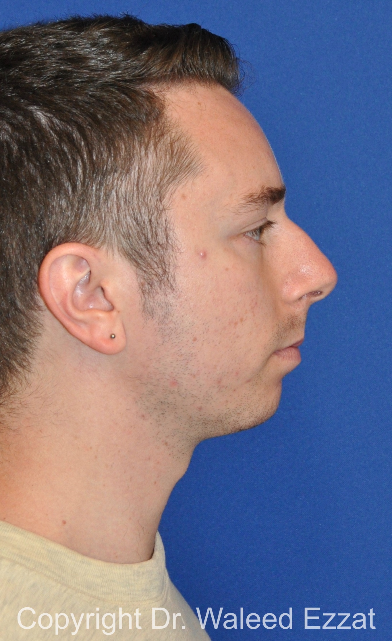 Chin Augmentation Patient Photo - Case 37 - before view-2