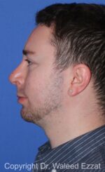 Chin Augmentation - Case 37 - After