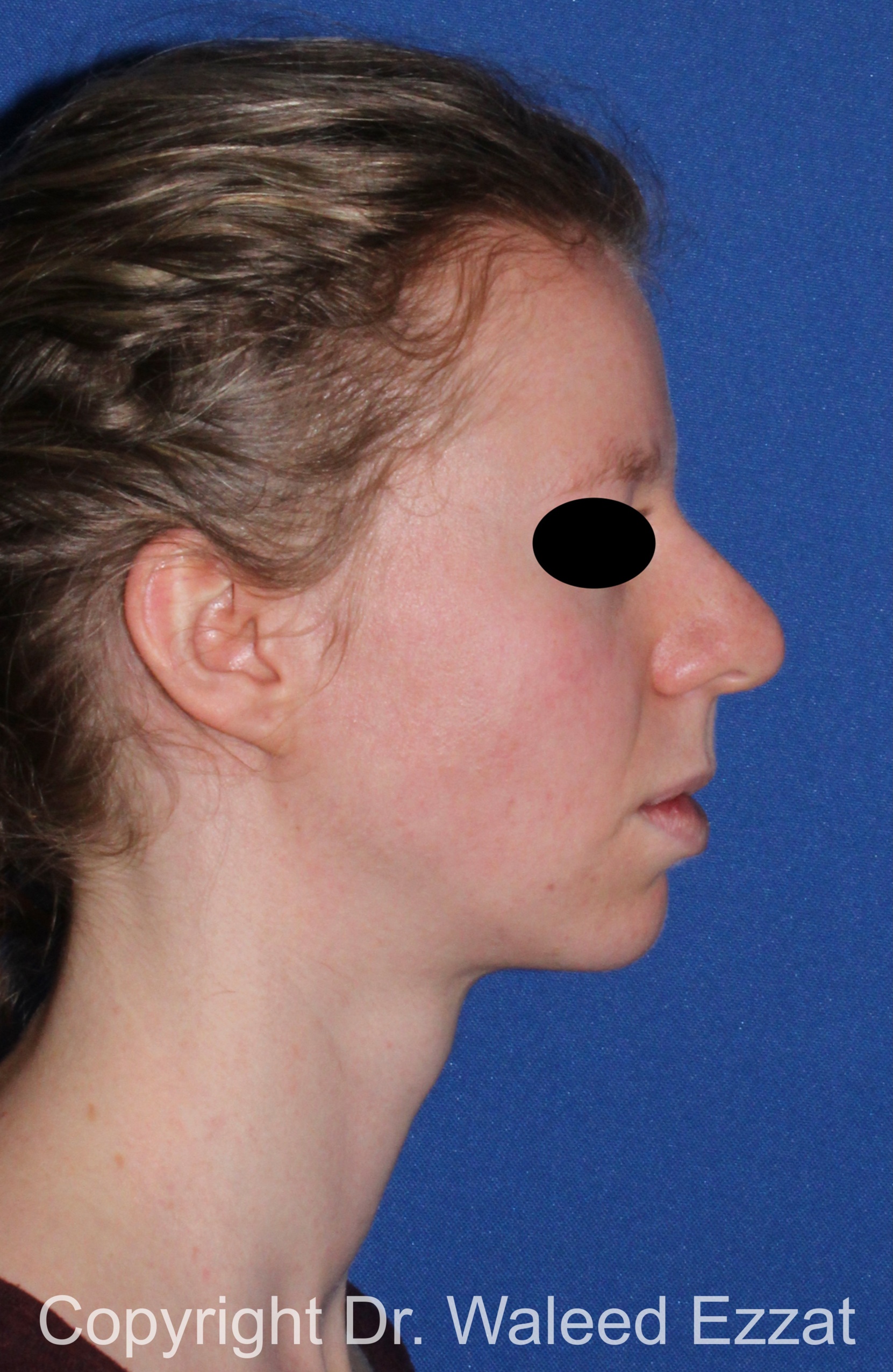 Chin Augmentation Patient Photo - Case 38 - before view-