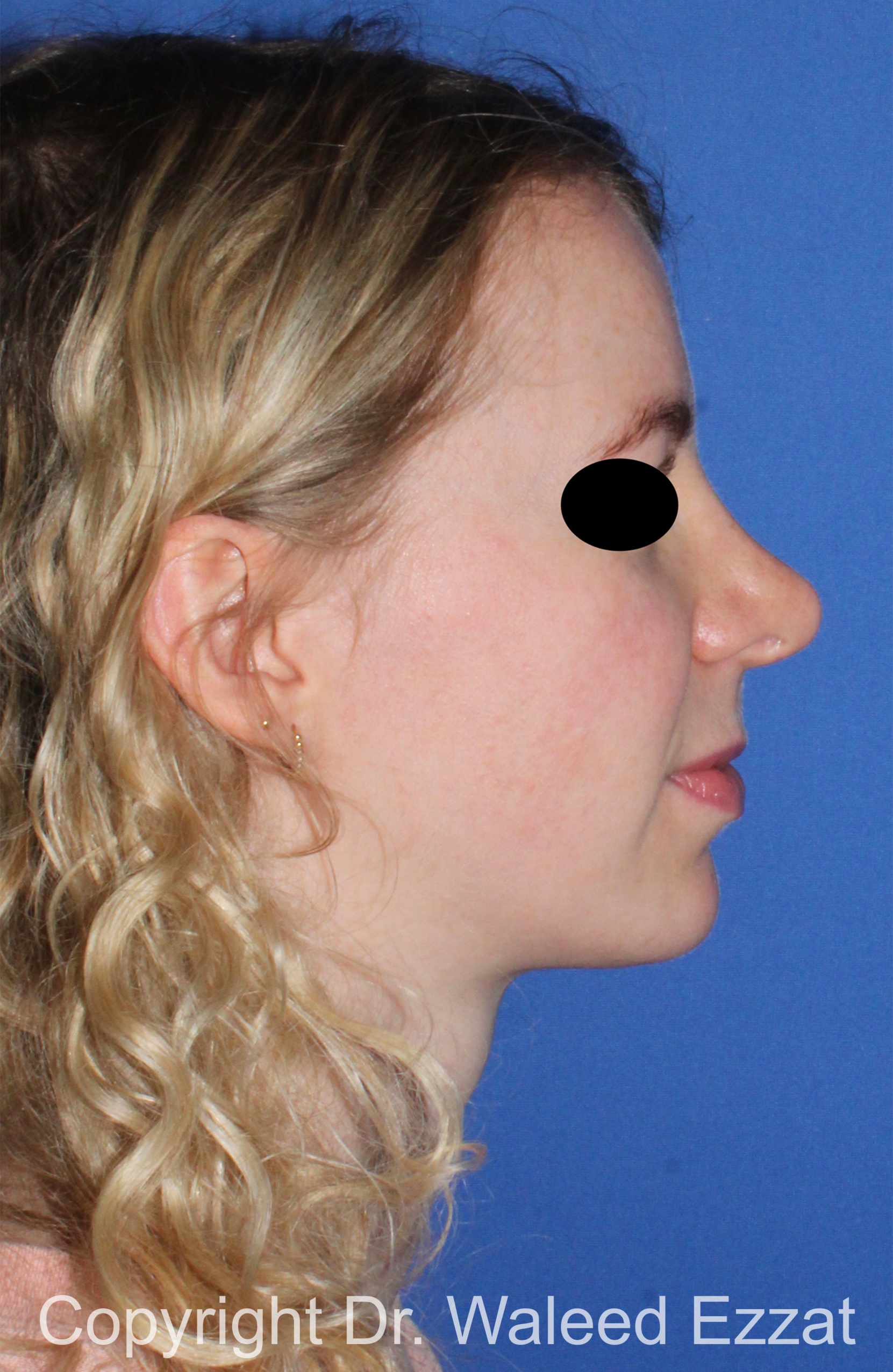 Chin Augmentation Patient Photo - Case 38 - after view