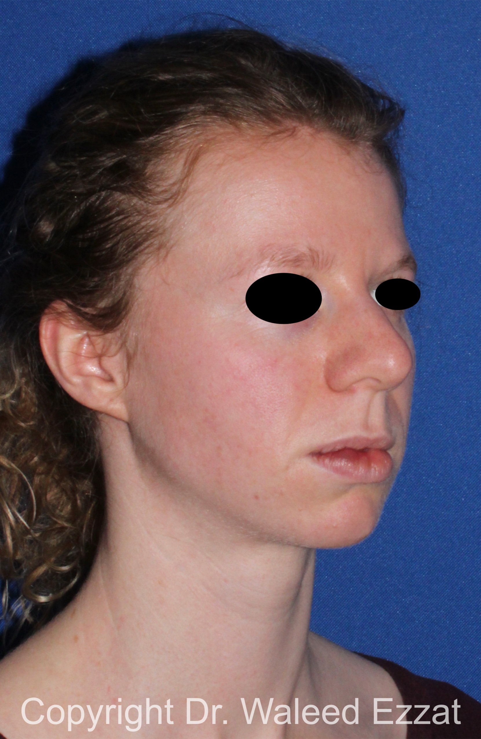 Chin Augmentation Patient Photo - Case 38 - before view-1