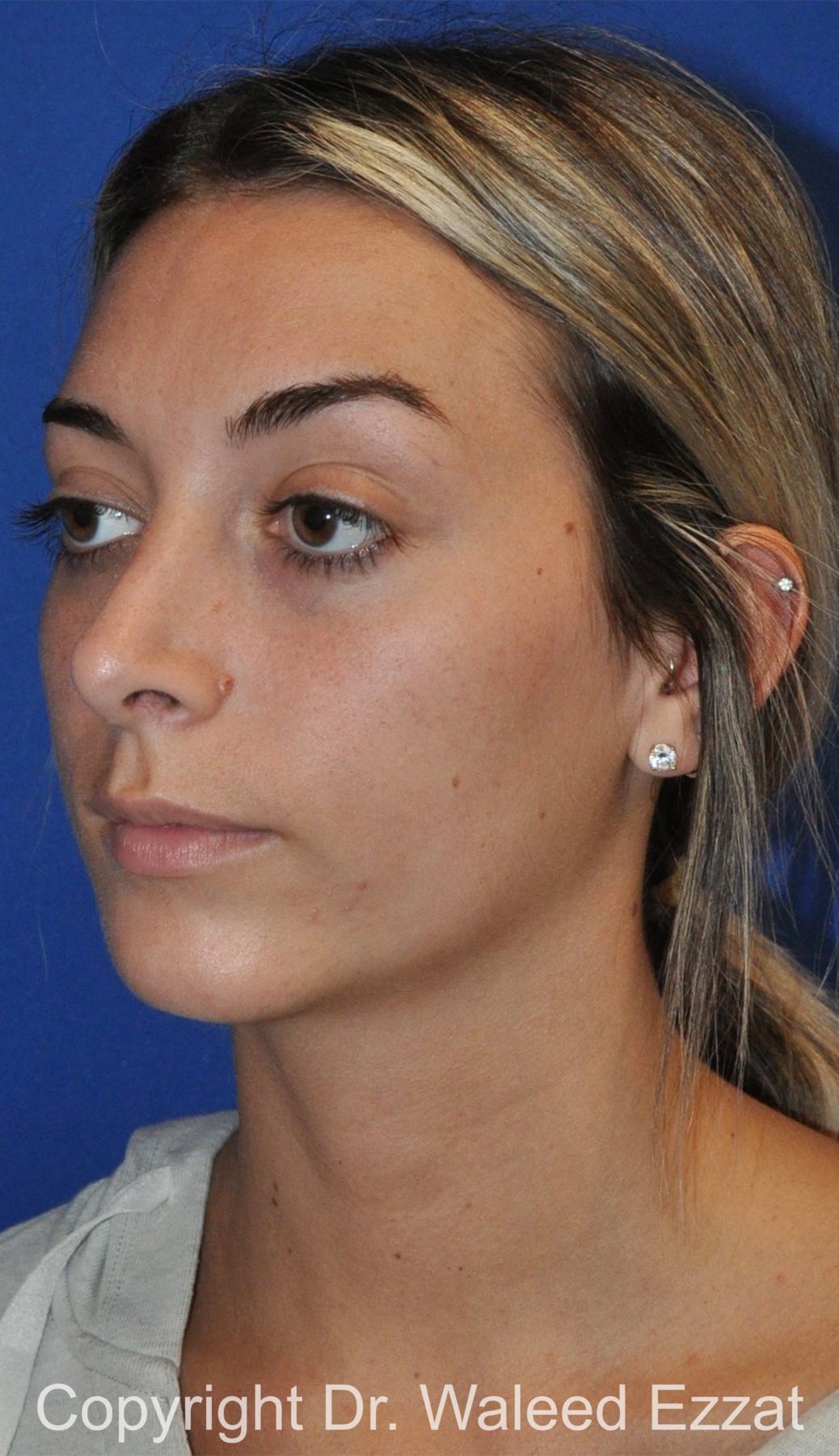 Chin Augmentation Patient Photo - Case 39 - after view-1