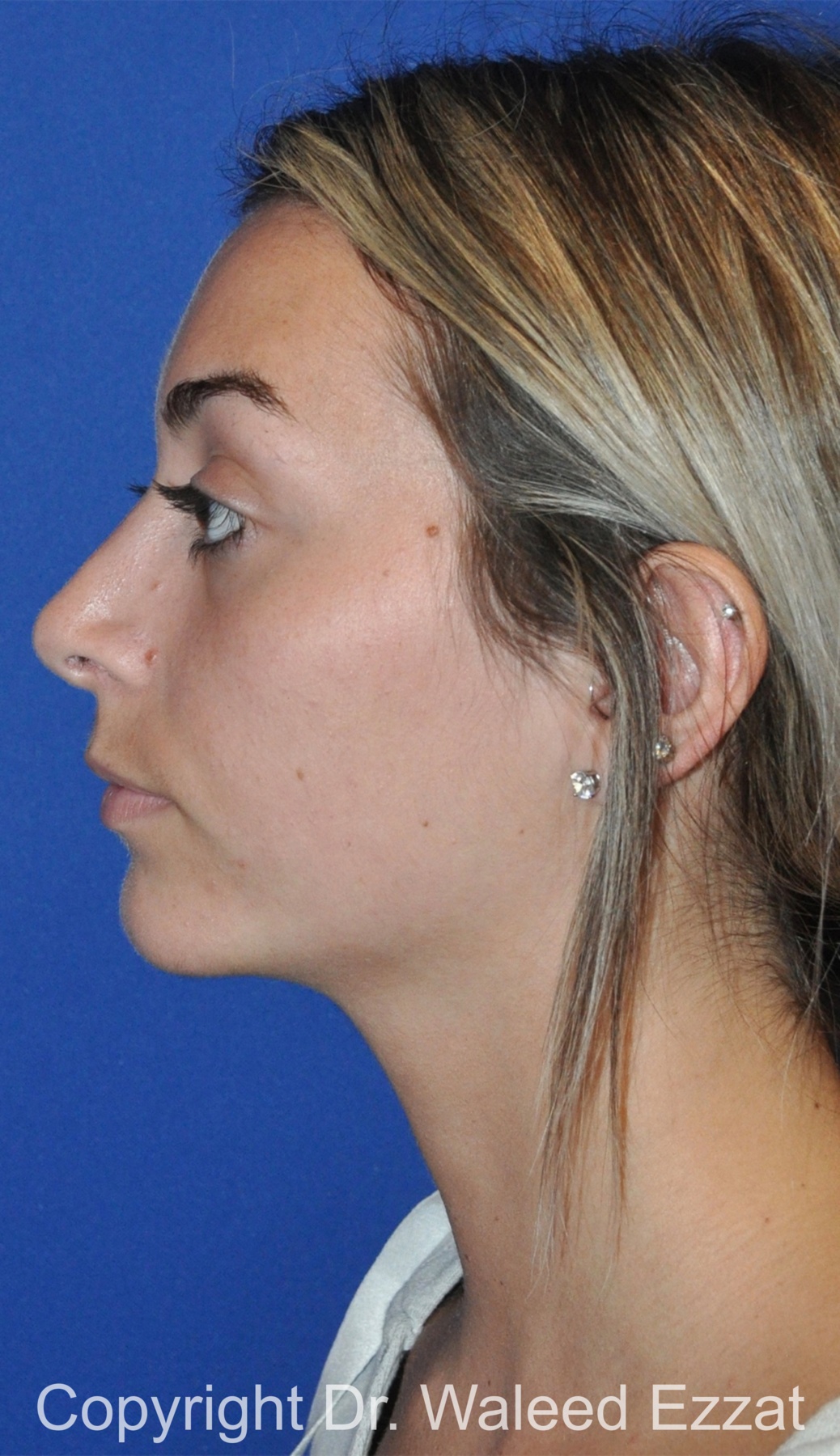 Chin Augmentation Patient Photo - Case 39 - after view