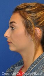 Chin Augmentation - Case 39 - Before