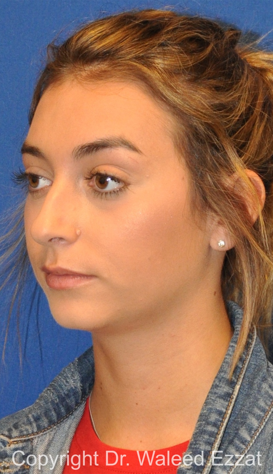 Chin Augmentation Patient Photo - Case 39 - before view-1