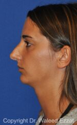 Chin Augmentation - Case 40 - Before