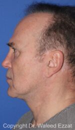 Facelift - Case 2 - After
