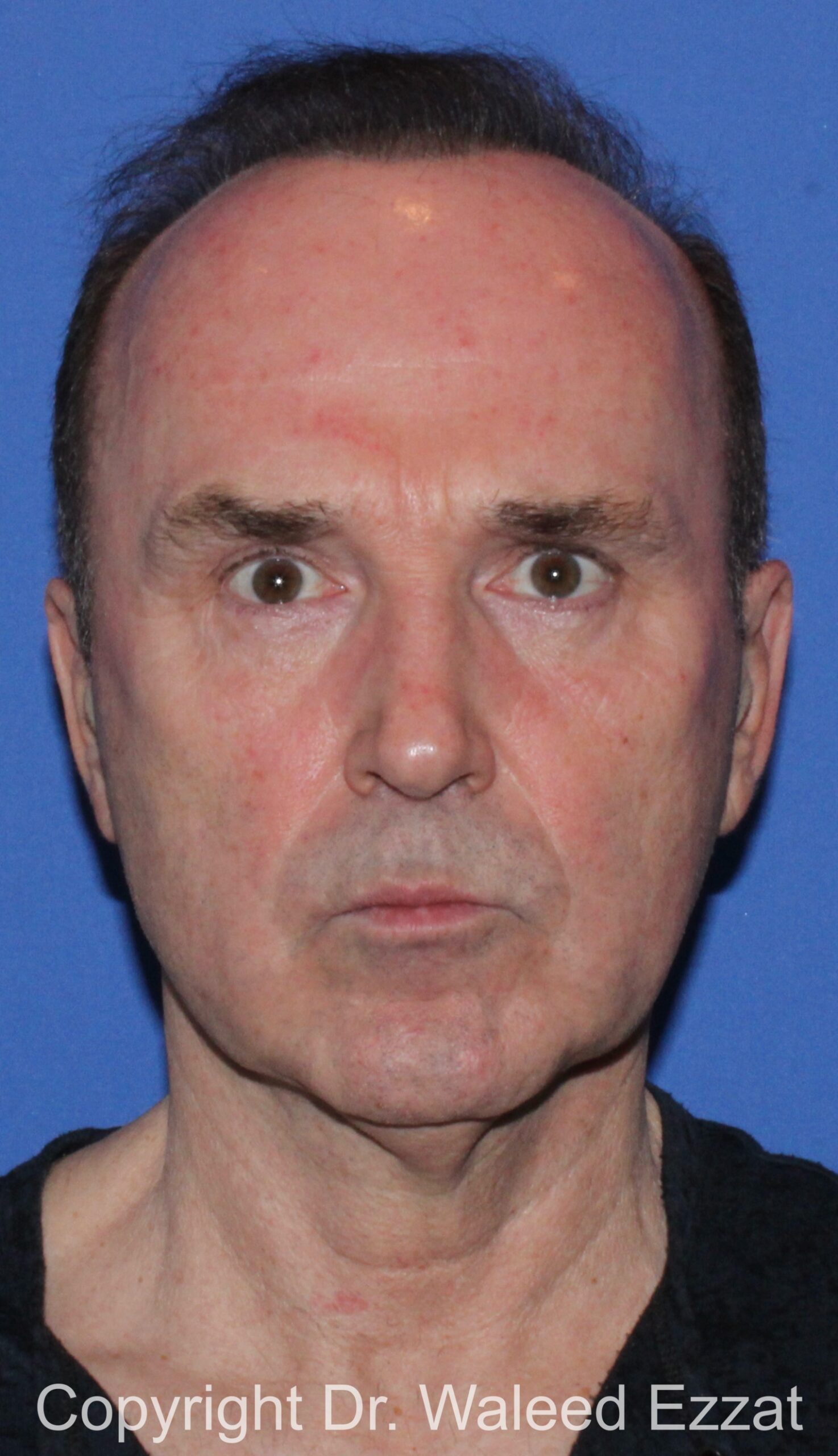 Facelift Patient Photo - Case 2 - before view-2