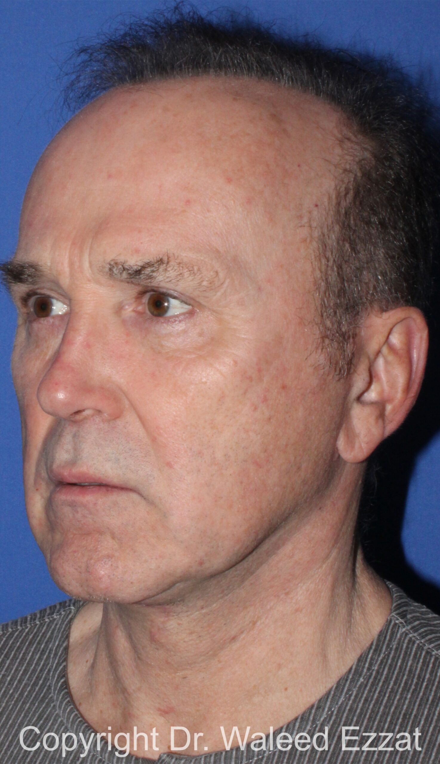 Facelift Patient Photo - Case 2 - after view-1