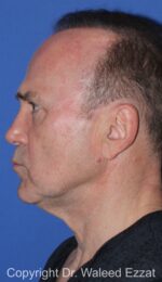 Facelift - Case 2 - Before