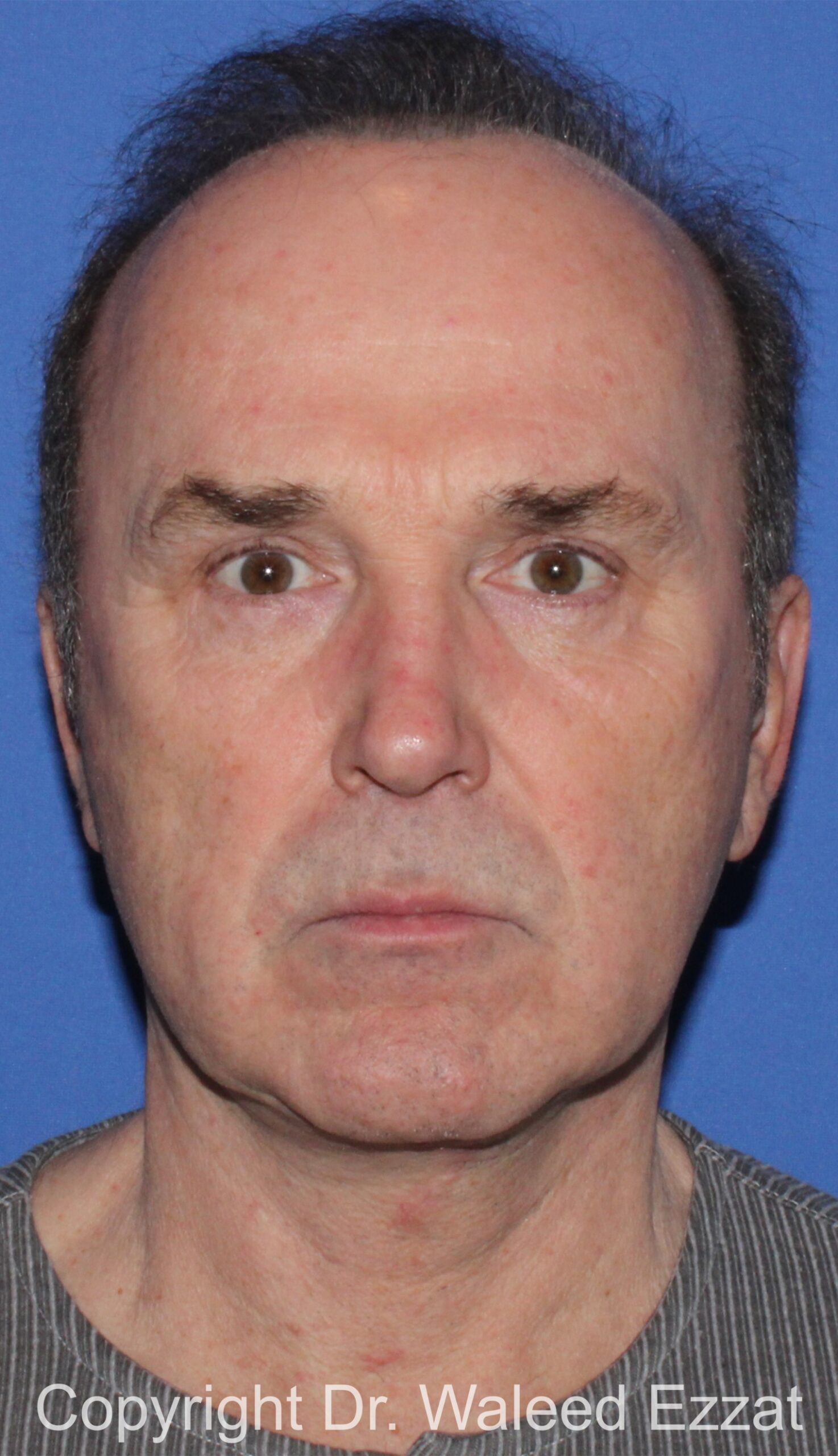 Facelift Patient Photo - Case 2 - after view-2