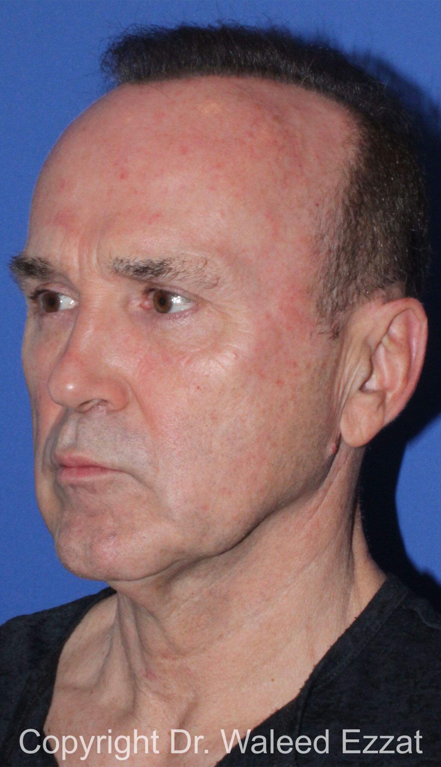 Facelift Patient Photo - Case 2 - before view-1