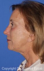 Facelift - Case 5 - After