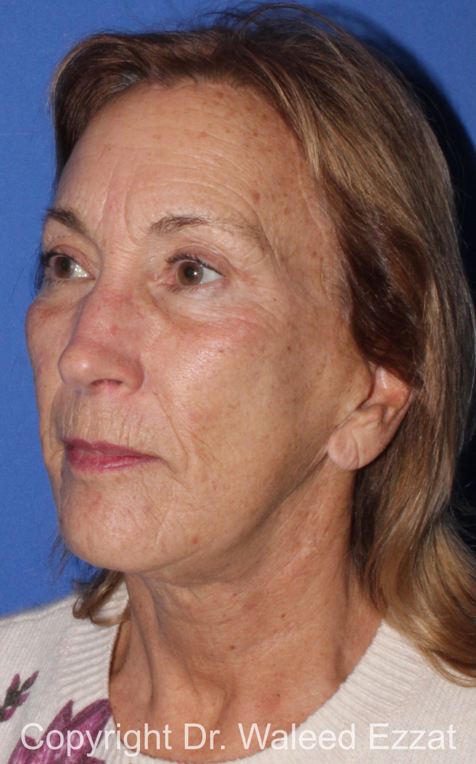 Facelift Patient Photo - Case 5 - after view-1