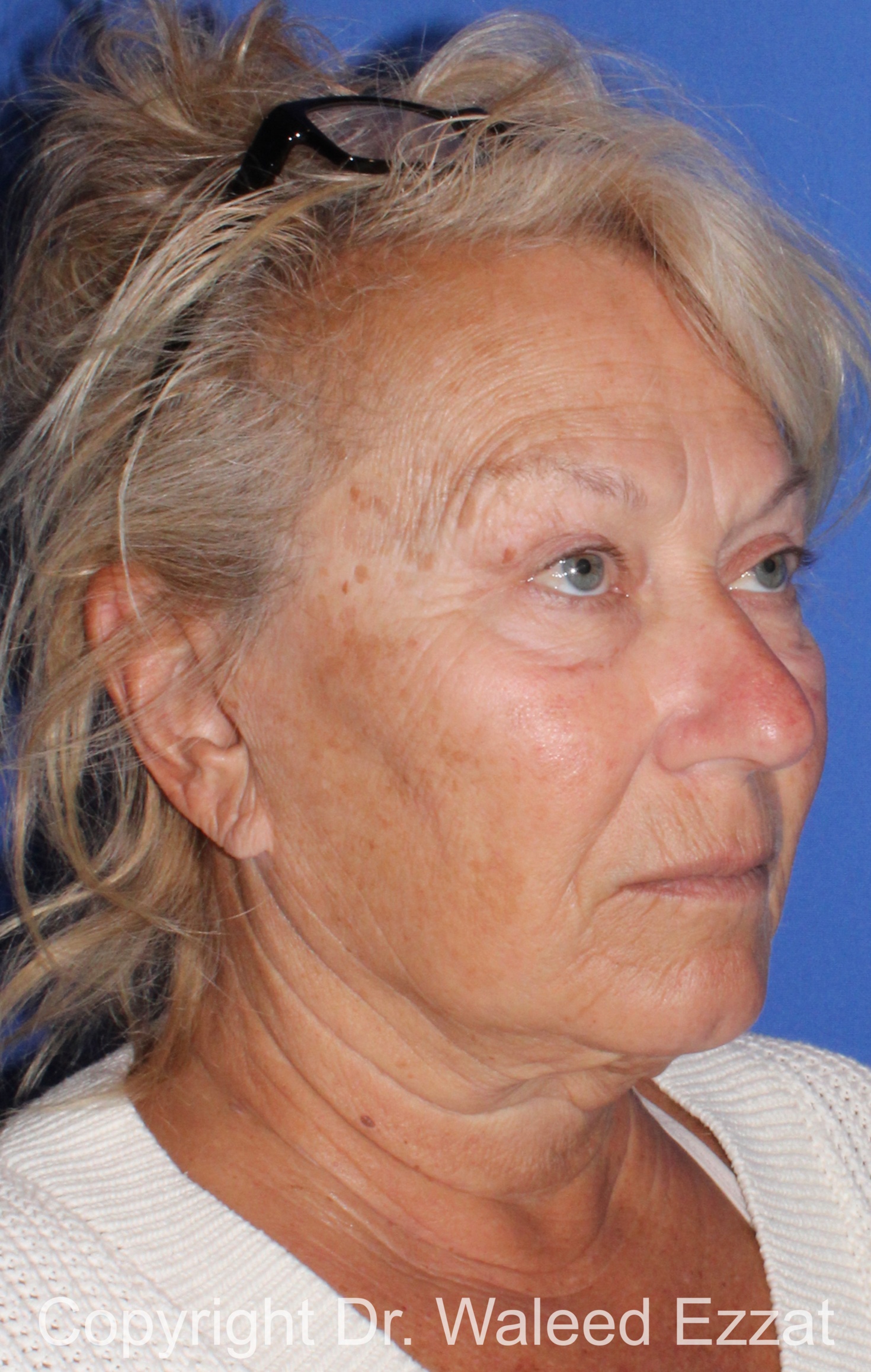 Facelift Patient Photo - Case 6 - before view-1