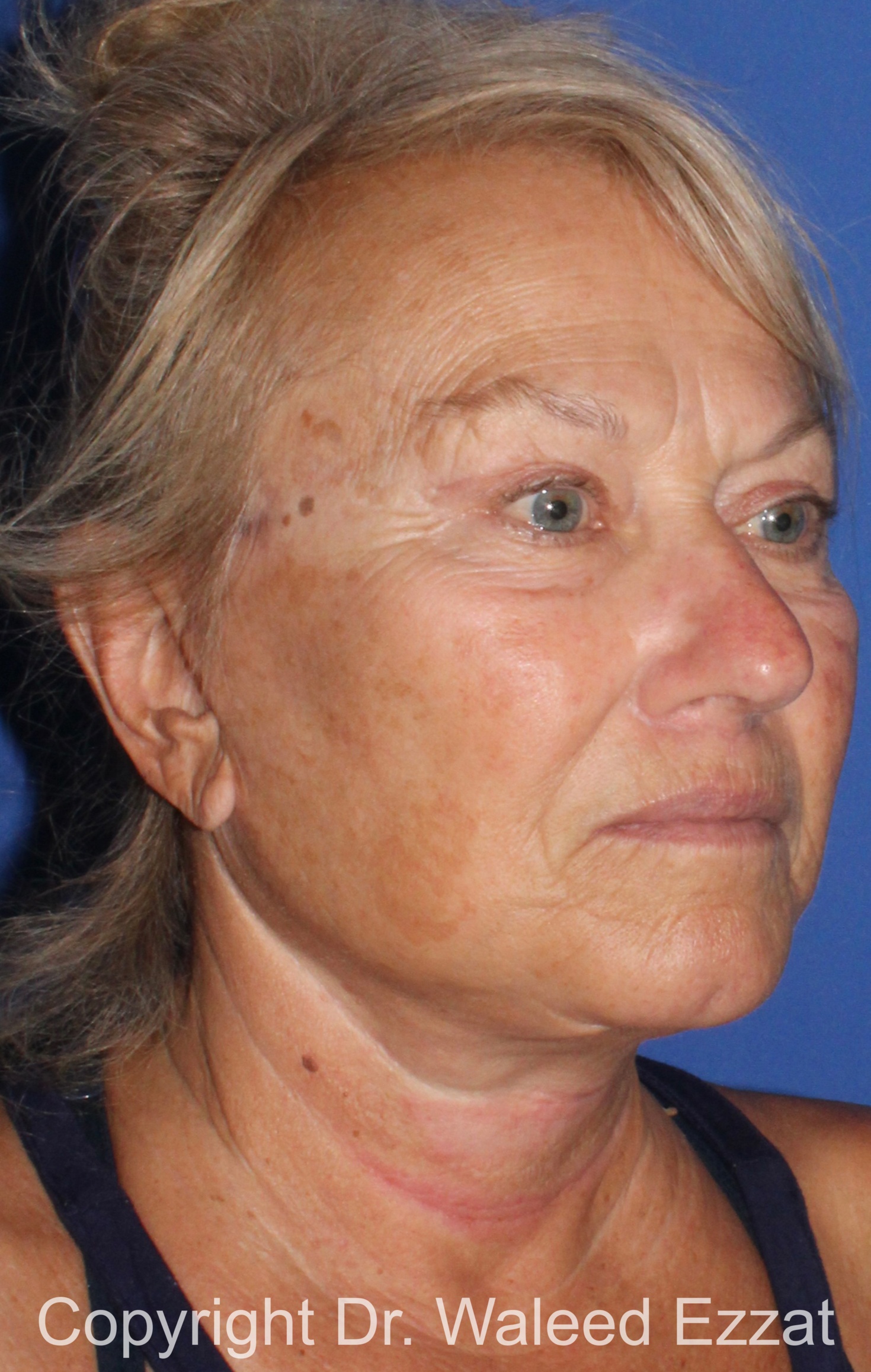 Facelift Patient Photo - Case 6 - after view-1