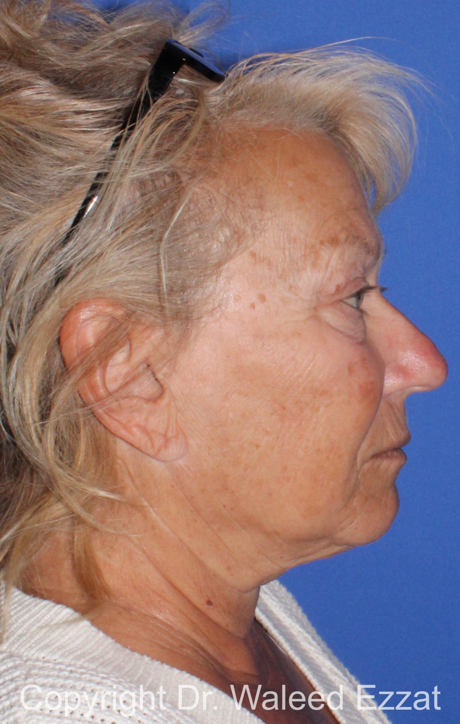 Facelift Patient Photo - Case 6 - before view-
