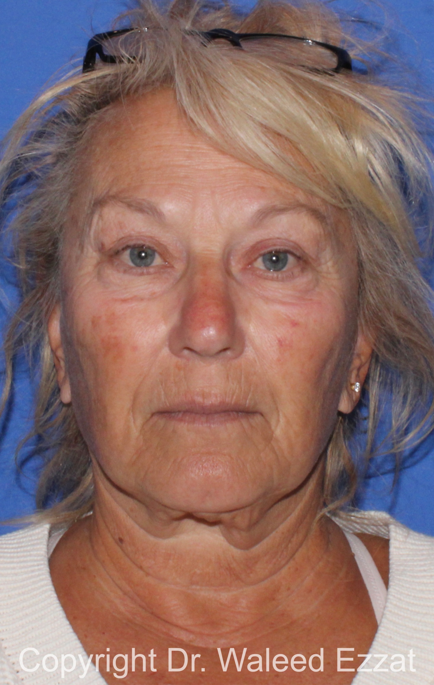 Facelift Patient Photo - Case 6 - before view-2