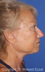 Facelift - Case 6 - After